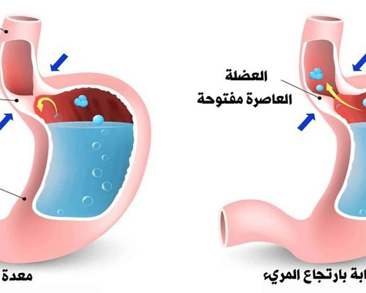 ارتجاع المريء - الأستاذ الدكتور زكريا محمد زكريا, image size:1280x1024