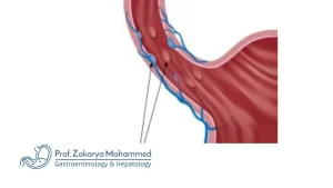 حقن دوالي المعدة