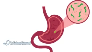 علاج جرثومة المعدة في أسبوع
