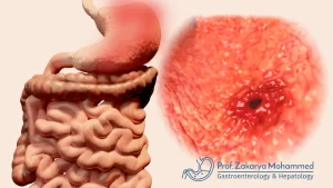 علاج قرحة المعدة بالمنظار