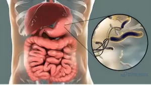 هل جرثومة المعدة تسبب دوار
