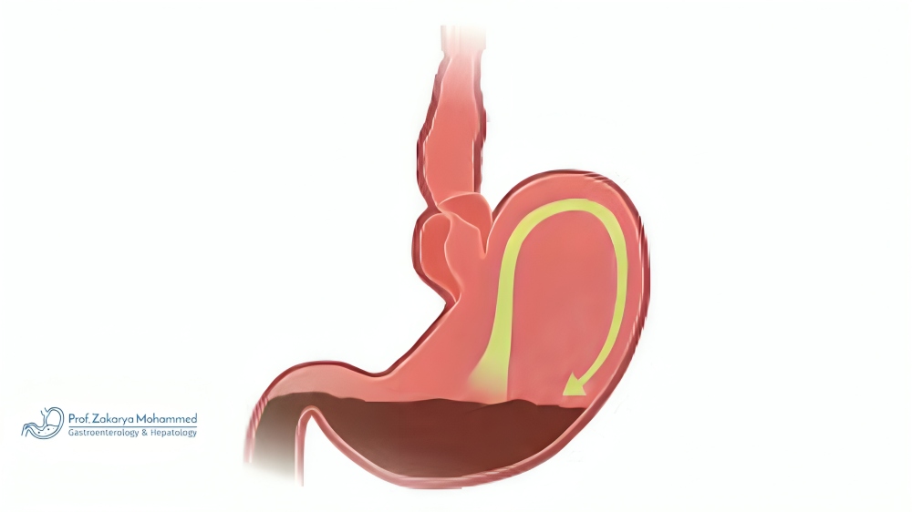 علاج الارتجاع المريئي