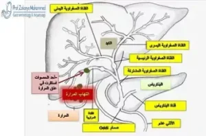 أعراض المرارة عند النساء