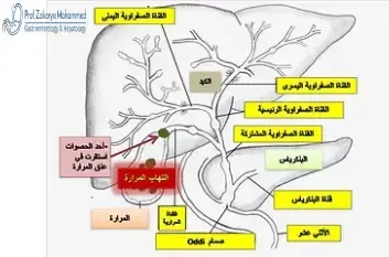 أعراض المرارة عند النساء