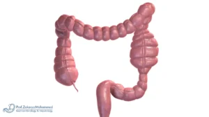 أفضل دكتور لعلاج مرض كرون