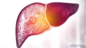 افضل دكتور لعلاج دهون الكبد