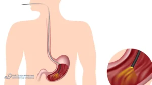 طريقة عمل منظار المعدة