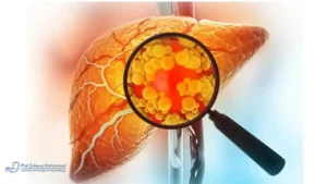 هل دهون الكبد خطيرة