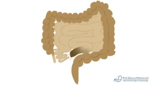 هل انسداد الأمعاء يسبب الوفاة؟